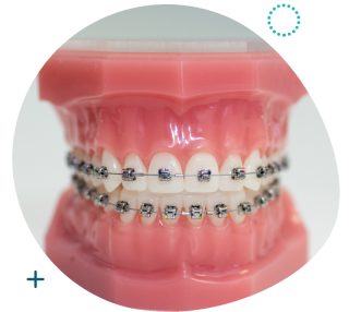 Damon Q: Self-Ligating Braces And Brackets Singapore