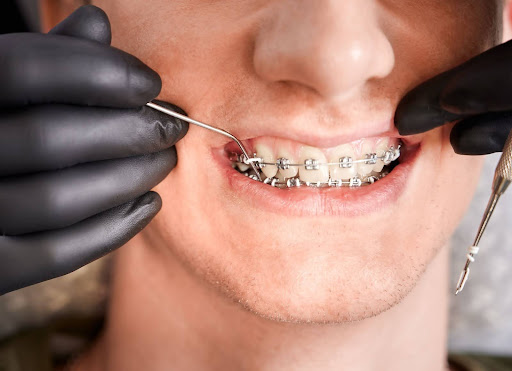 teeth braces being adjusted