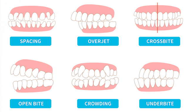 What Can Invisalign Treat