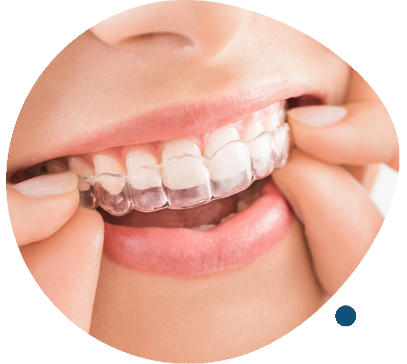 Affordable Invisalign in SIngapore