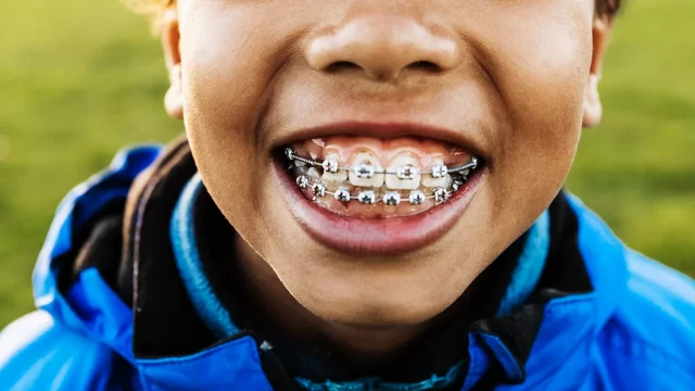 Dental Braces