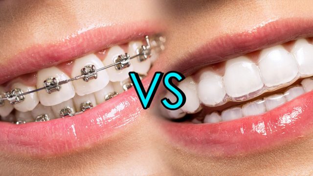 Traditional Braces vs Invisalign