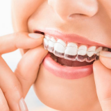 Invisalign Price Singapore