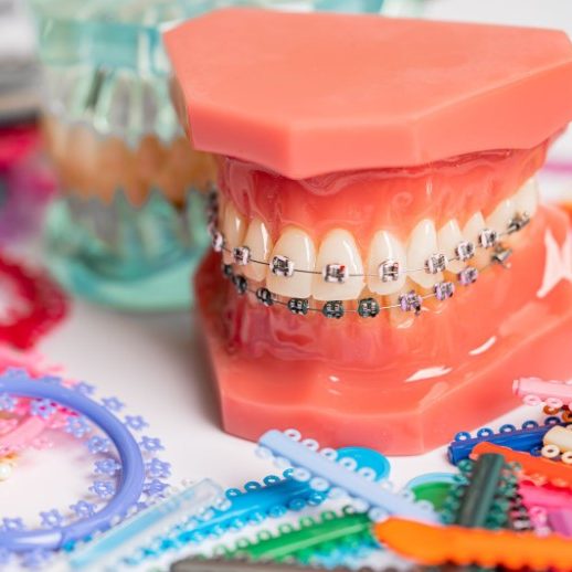 Braces Components & How Do They Work