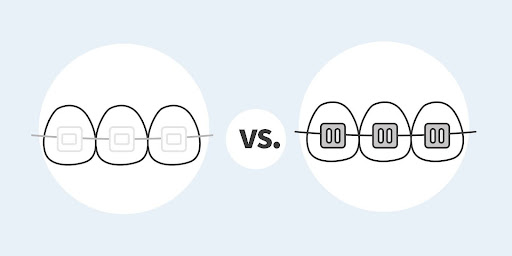 Clear vs Metal Braces