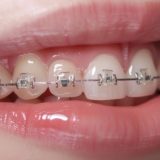 Clear Braces in Singapore