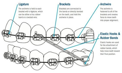 components of teeth braces