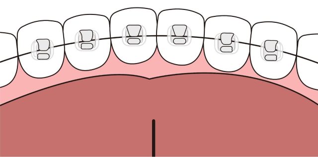 Lingual Braces Example