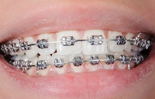 teeth braces components