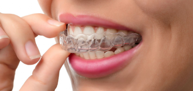 Type of Invisalign Aligner