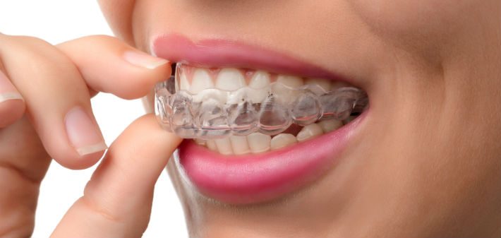 Types of Invisalign Aligners & Cost