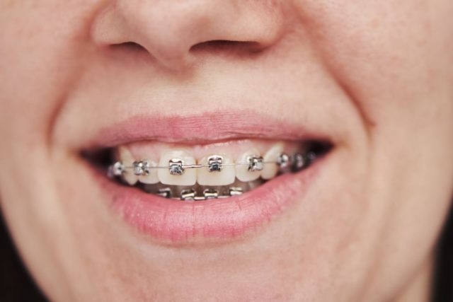 Self Ligating Braces - 5 Things You Need to Know