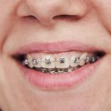 Self ligating braces