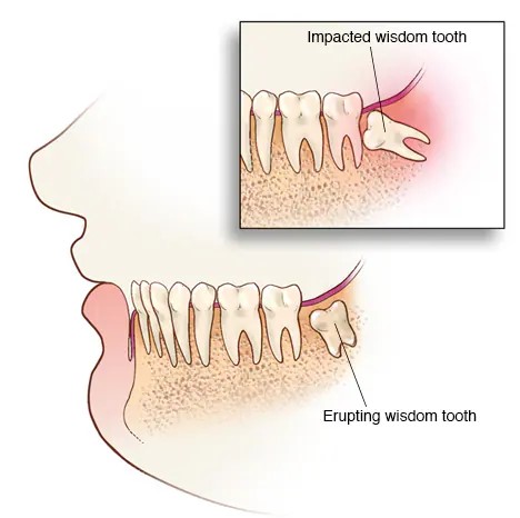 graph of wisdom tooth