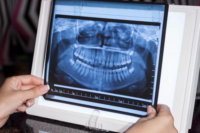 An x-ray of dental teeth