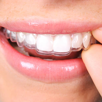 Invisible Braces Singapore: Your Guide to a Confident Smile