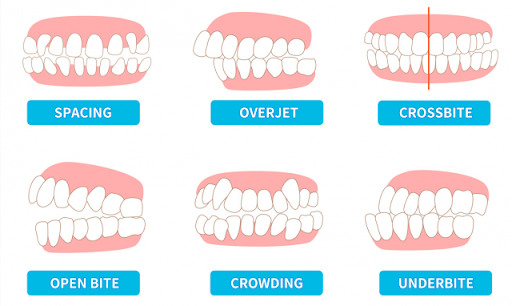 What Conditions Can Invisible Braces Treat?