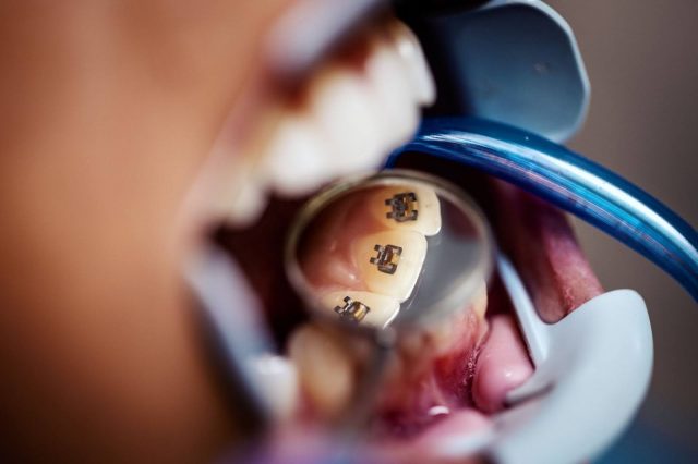 doctor checking lingual braces