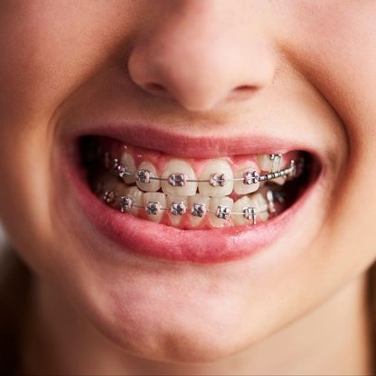 Foods That Can Break Braces: What to Avoid During Treatment