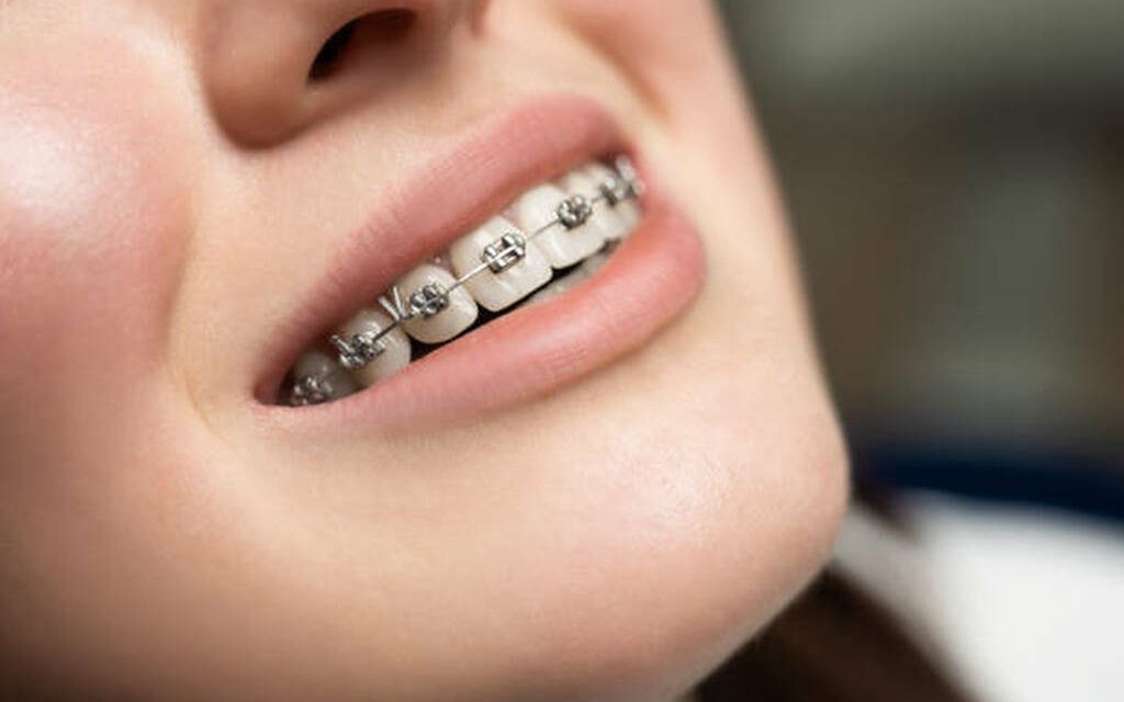 How Braces Can Improve Your Face Shape and Jawline