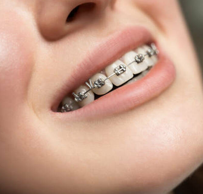 How Braces Can Improve Your Face Shape and Jawline