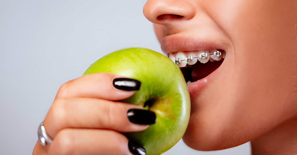 Can I Eat Normally After Braces Are Removed?
