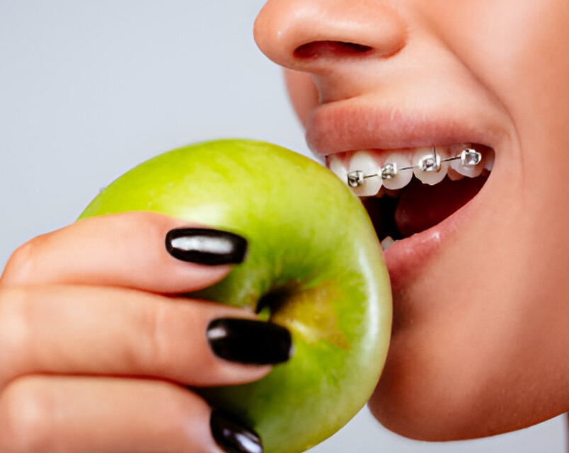 Can I Eat Normally After Braces Are Removed?