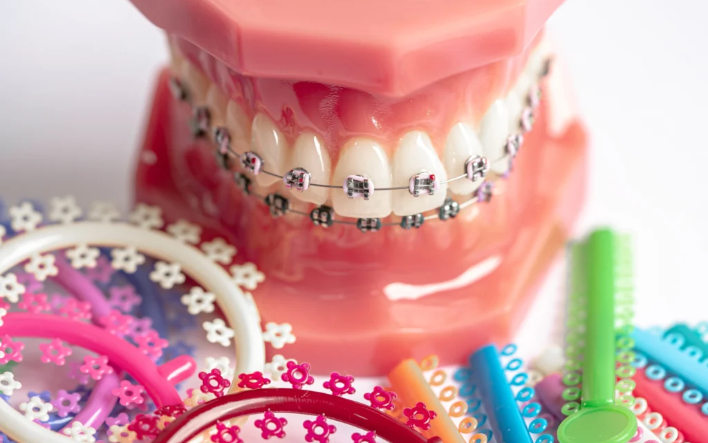 Why You Should Avoid Fashion Braces: The Hidden Risks to Your Teeth