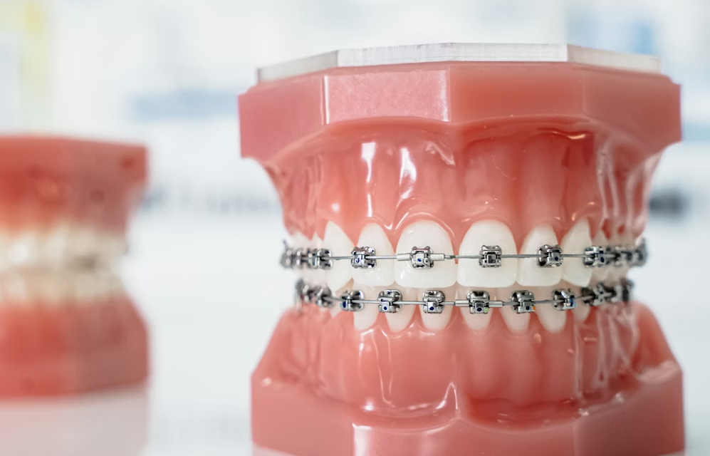 Braces Pain: Why It Happens and How to Manage Discomfort During Orthodontic Treatment