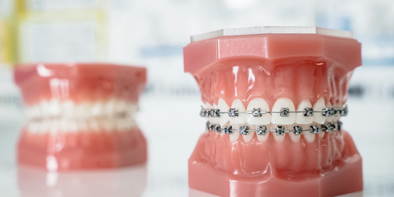 Braces Pain: Why It Happens and How to Manage Discomfort During Orthodontic Treatment