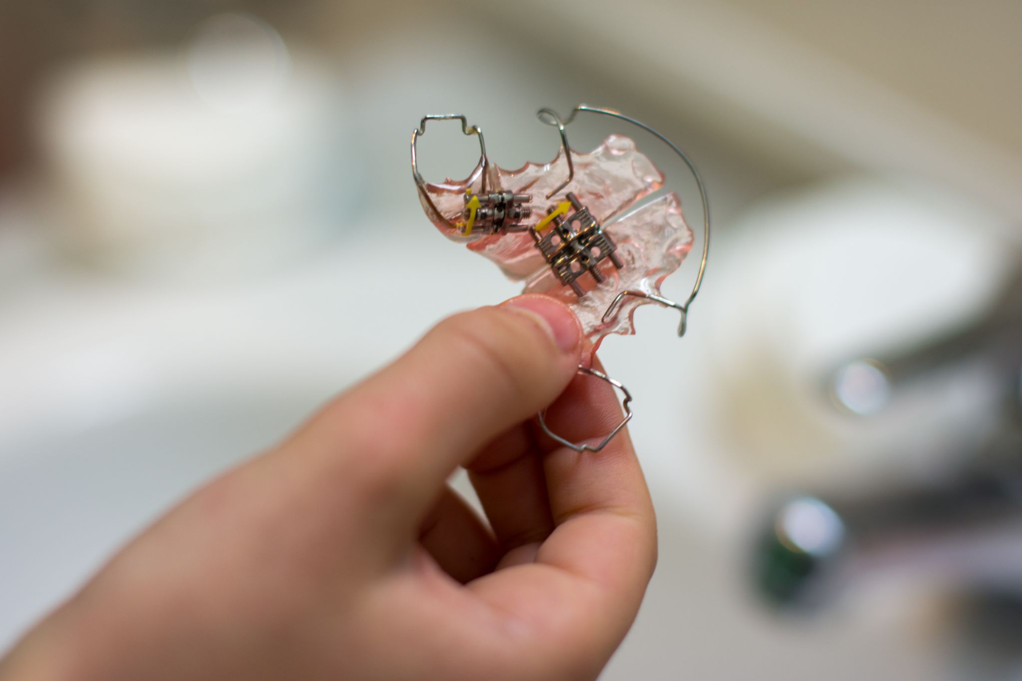 Palate Expander Treatment
