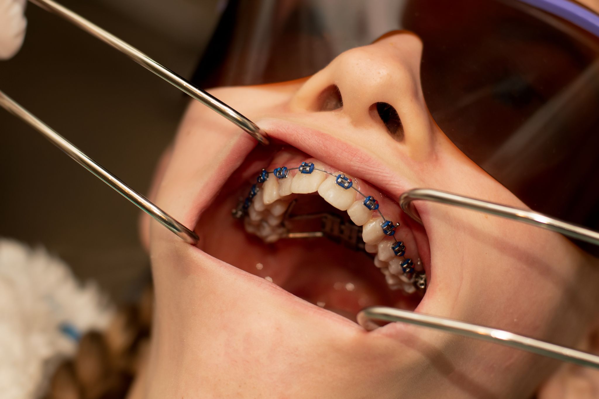 Recommended Palate Expander