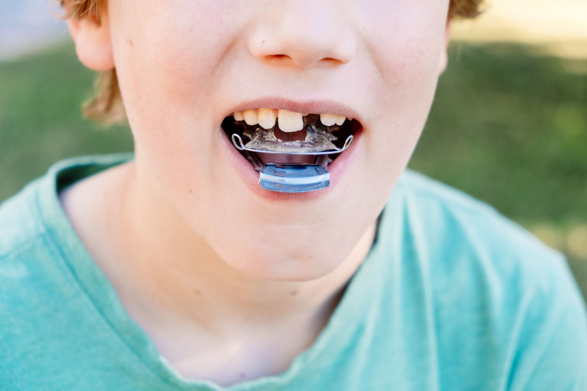 Types of Palate Expander