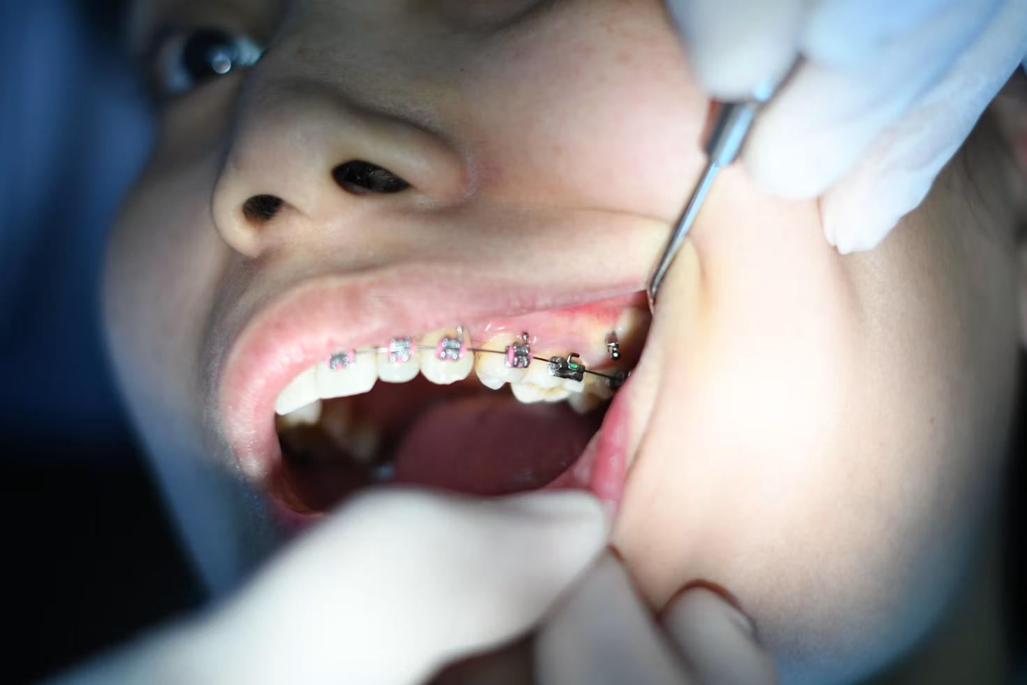 treatment option for malocclusion