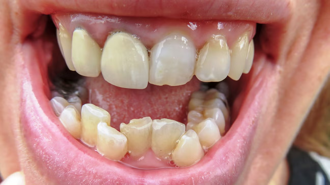 what is malocclusion