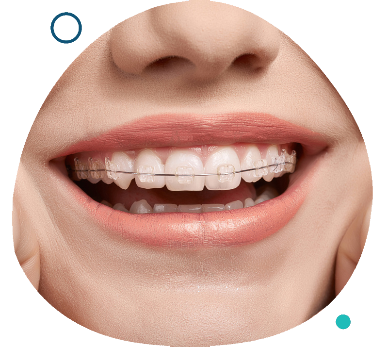 Ceramic Braces in Singapore