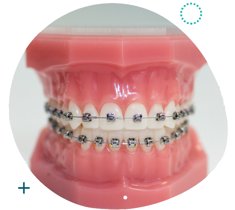 Damon Braces in Singapore