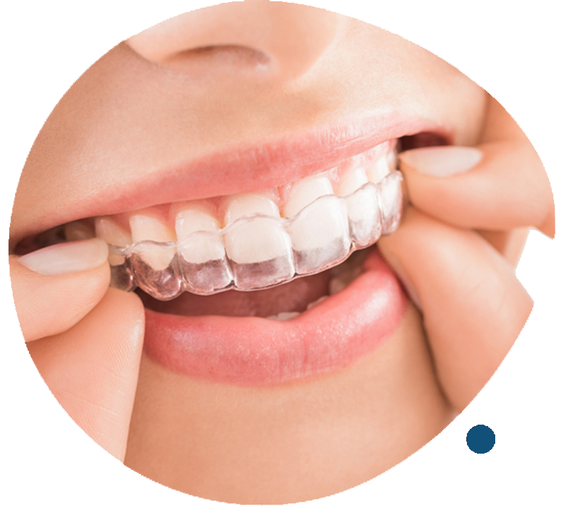 Invisalign Braces in Singapore