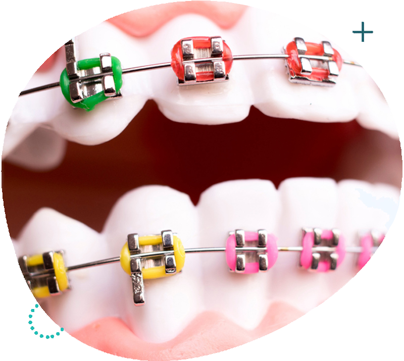 Metal Braces in Singapore
