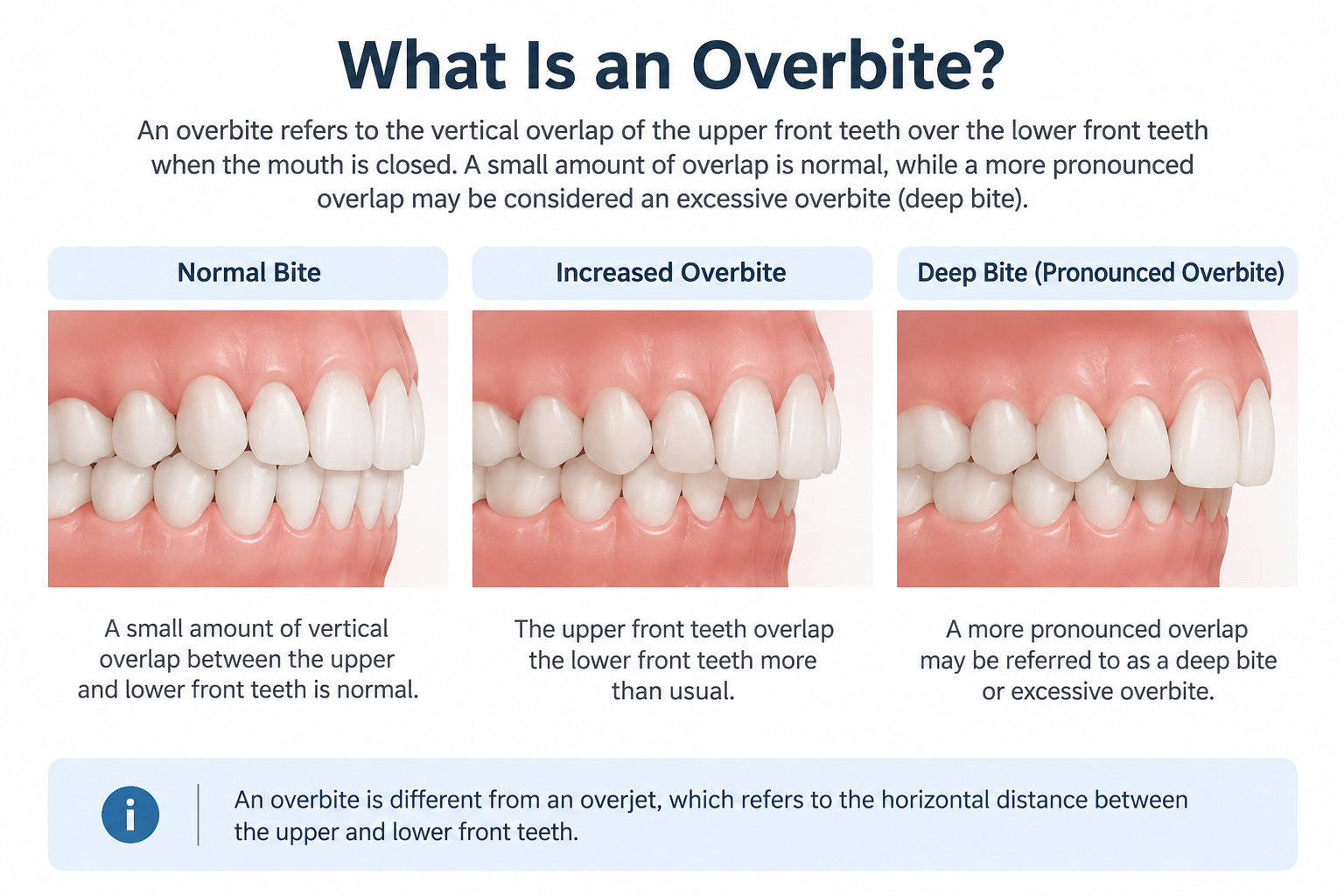 What Is an Overbite?