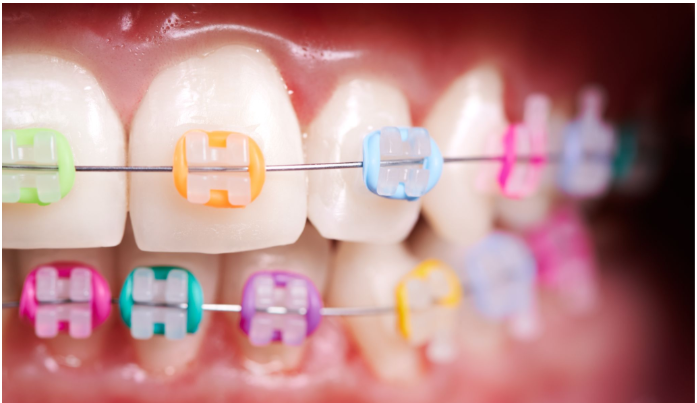 Can You Make Braces Work Faster?