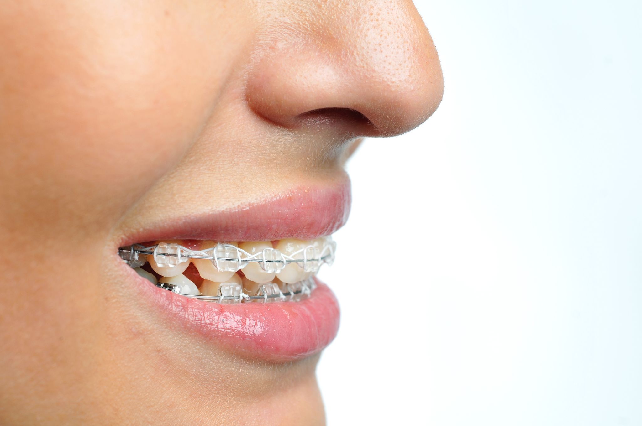 How Long Do Braces Take?