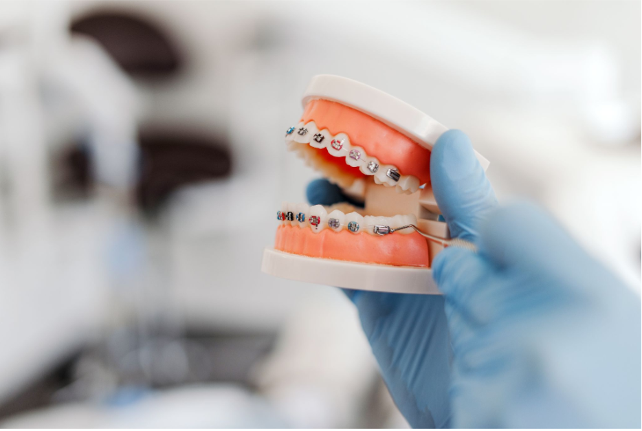 Timeline for Braces: How Long Does it Take?