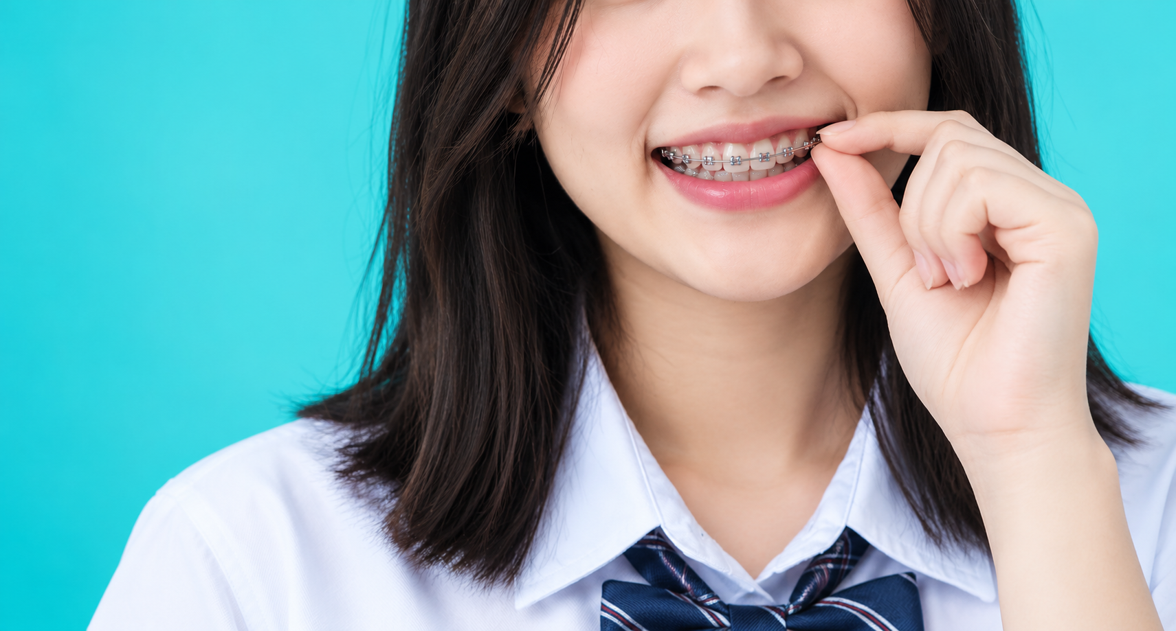 Are Metal Braces Affordable in Singapore?