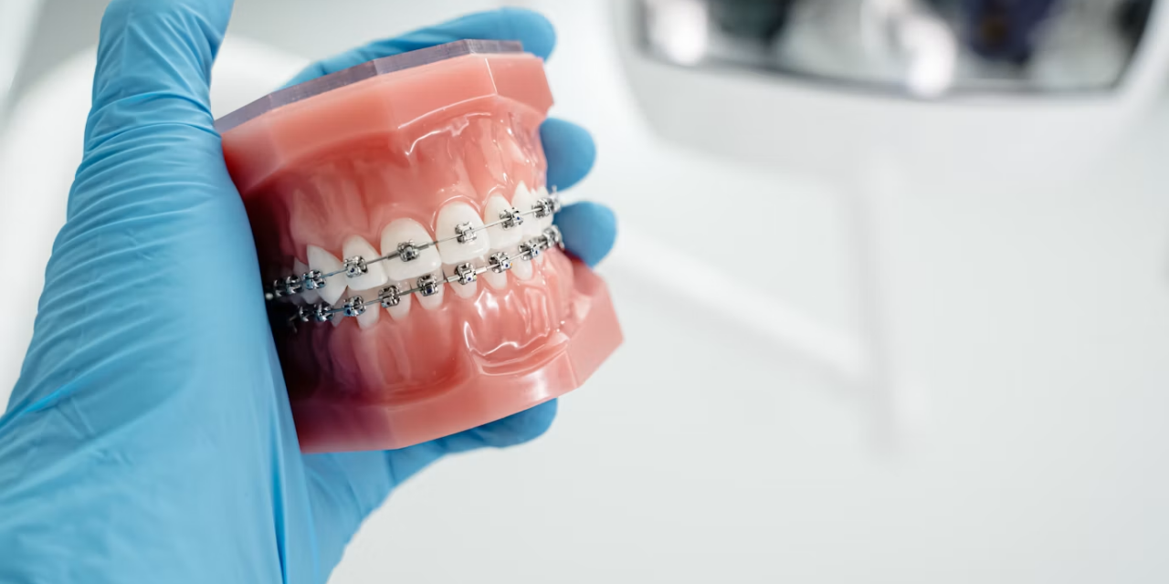 How Much Do Metal Braces Cost in Singapore?